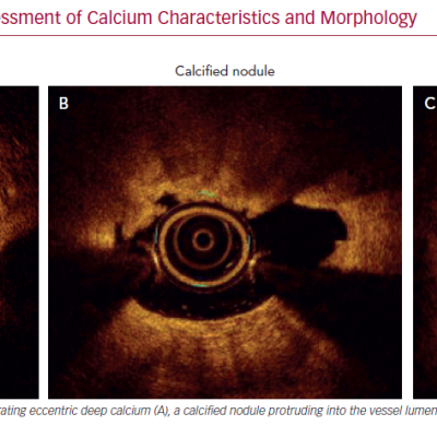 Intravascular Imaging Assessment of Calcium