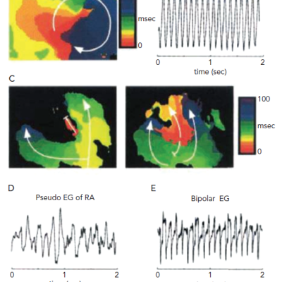 Figure 1 Isochrone Maps and Pseudo-Electrograms During an Episode of AF