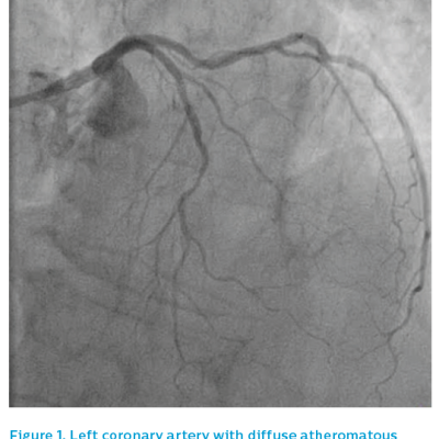 Figure 1. Left coronary artery with diffuse atheromatous disease and severe lesion