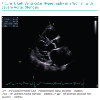 Left Ventricular Hypertrophy in a Woman with Severe Aortic Stenosis