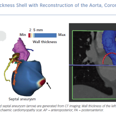 Left Ventricular Wall Thickness Shell with Reconstruction
