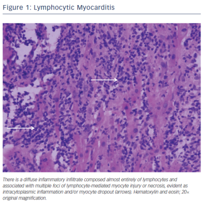 Figure 1 Lymphocytic Myocarditis