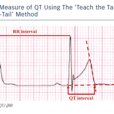 Figure 1 Measure of QT Using The ‘Teach the Tangent Avoid-the-Tail’ Method