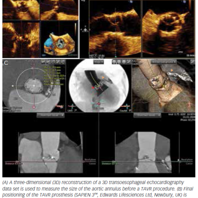 Figure 1 Multimodality Imaging to Evaluate a Patient for Transcatheter Aortic Valve Replacement TAVR