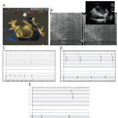 Figure 1 Patient with PLSVC who Underwent AF Catheter Ablation