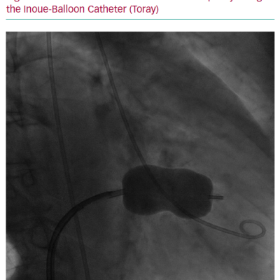 Percutaneous Mitral Balloon Valvuloplasty Using the Inoue-Balloon Catheter Toray
