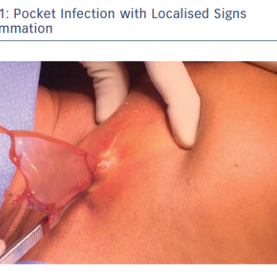 Pocket Infection with Localised Signs of Inflammation