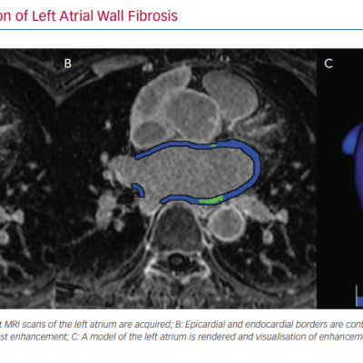 Process of Quantification of Left Atrial Wall Fibrosis