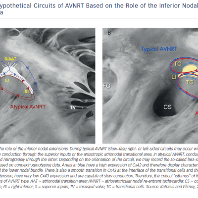 Proposed and Hypothetical Circuits of AVNRT Based on the Role of the Inferior Nodal Extensions and Connexin Genotyping Data