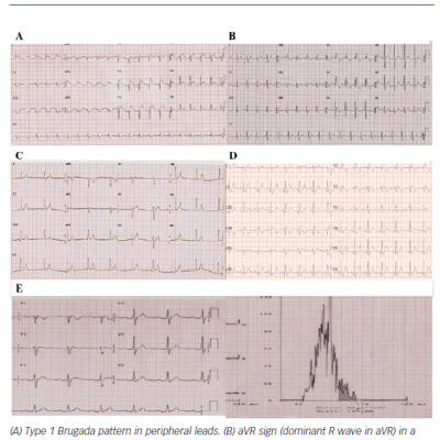 Figure 1 Proposed ECG Markers with Evidence of a Role in Predicting Ventricular Arrhythmias in Brugada Syndrome