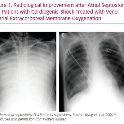 Radiological Improvement after Atrial Septostomy in a Patient