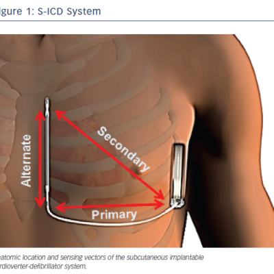 Figure 1 S-ICD System