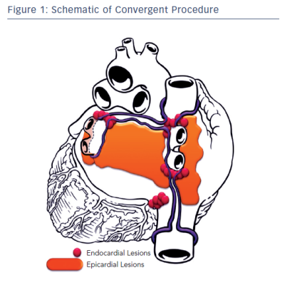 Figure 1 Schematic of Convergent Procedure