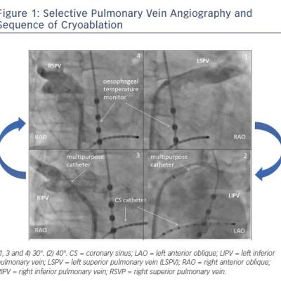 Figure 1 Selective Pulmonary Vein Angiography and Sequence of Cryoablation