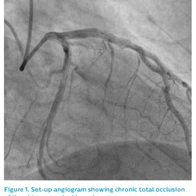 Figure 1. Set-up angiogram showing chronic total occlusion of the obtuse marginal branch