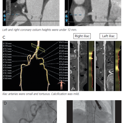 Figure 1 Small Aortic Complex in an 84-year-old Woman with a Body Surface Area of 1.23 m2