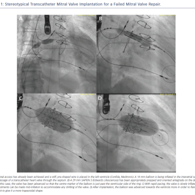 Figure 1 Stereotypical Transcatheter Mitral Valve Implantation for a Failed Mitral Valve Repair
