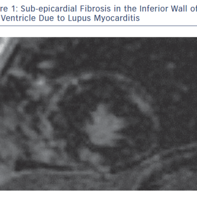 Sub-epicardial Fibrosis in the Inferior Wall