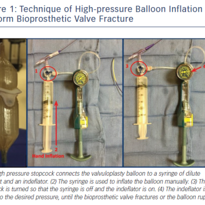 Figure 1 Technique of High-pressure Balloon Inflation to Perform Bioprosthetic Valve Fracture