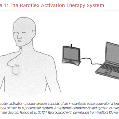 The Baroflex Activation Therapy System
