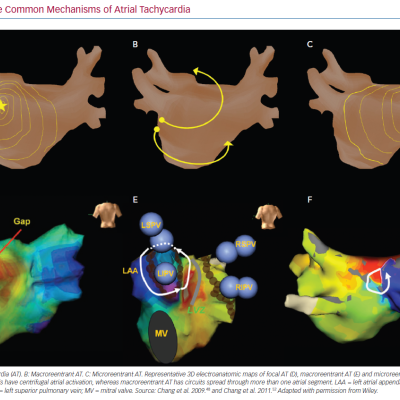 Three Common Mechanisms of Atrial Tachycardia