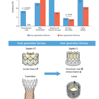 Figure 1 Transcatheter Aortic Valve Implantation With Early- and New-generation Devices in Bicuspid Aortic Valve Stenosis