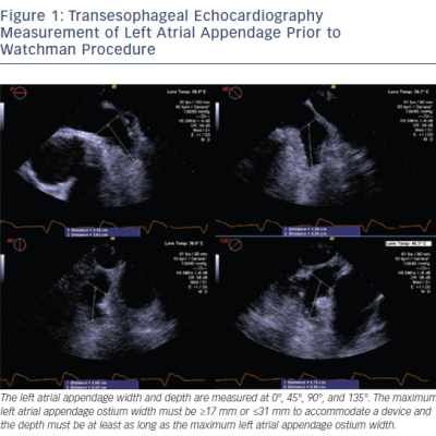 Figure 1 Transesophageal Echocardiography Measurement of Left Atrial Appendage Prior to Watchman Procedure