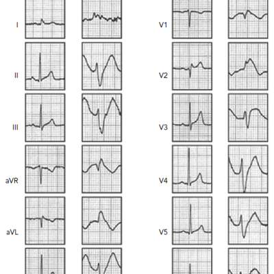 Figure 1 Twelve-lead ECG of a Man Aged 38 Years Presenting with Syncope