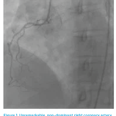 Figure 1. Unremarkable non-dominant right coronary artery
