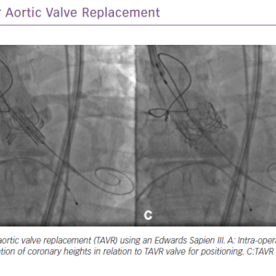 Valve-in-valve Transcatheter Aortic Valve Replacement