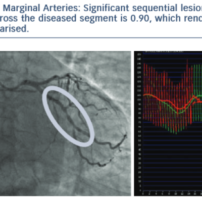 Circumflex Artery and Obtuse Marginal Arteries