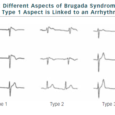 Figure 1 Different Aspects of Brugada Syndrome – Only the Type 1 Aspect is Linked to an Arrhythmic Risk