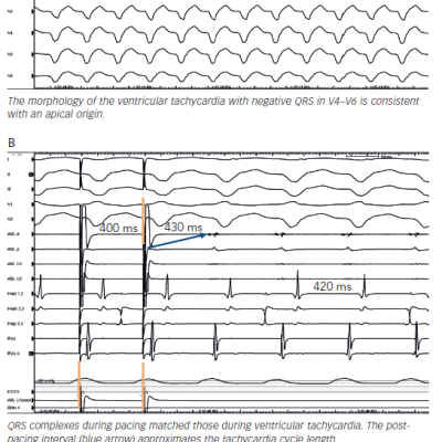 Figure 2 12-lead Electrocardiogram of Ventricular