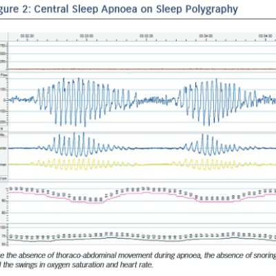 Central Sleep Apnoea on Sleep Polygraphy