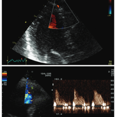 Evaluation of Coronary Flow in the Distal Part of LAD from Modified Apical View