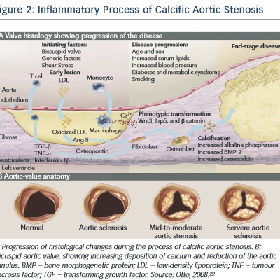 Inflammatory Process of Calcific Aortic Stenosis