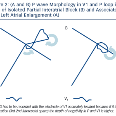 Figure 2 A and B P wave Morphology in V1 and P loop in a Case of Isolated Partial Interatrial Block B and Associated with Left Atrial Enlargement A