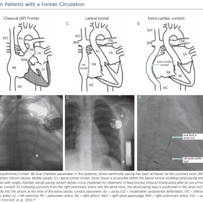 figure 2-Pacing-in-Patients-with-a-Fontan-Circulation