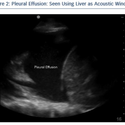 Pleural Effusion  Seen Using Liver as Acoustic Window