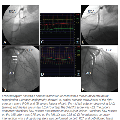 Figure 2 A 67-year-old Patient with Diabetes Admitted for Recurrent Chest Pain and had a Positive Exercise Test