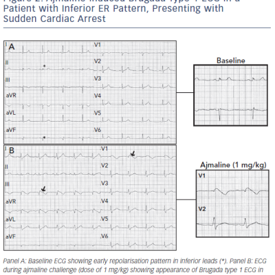 Figure 2 Ajmaline-induced Brugada Type 1 ECG in a Patient with Inferior ER Pattern Presenting with Sudden Cardiac Arrest