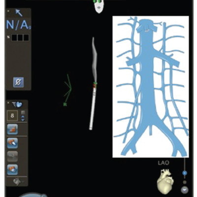 Anterior Catheter Direction May Lead from the Groin Area