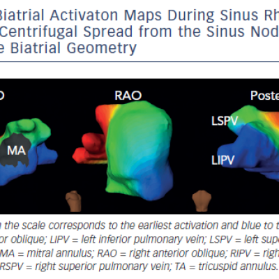 Figure 2 Biatrial Activaton Maps During Sinus RhythmShow the Centrifugal Spread from the Sinus Node to theRest of the Biatrial Geometry