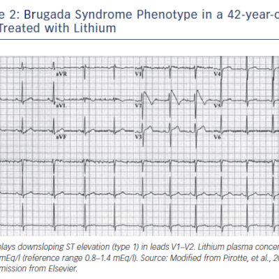 Brugada Syndrome Phenotype