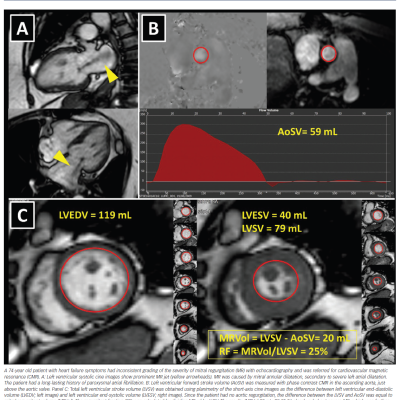 Figure 2 Cardiovascular Magnetic Resonance to Quantify Mitral Regurgitation