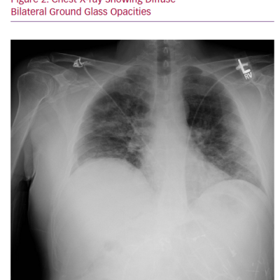 Chest X-ray Showing Diffuse Bilateral Ground Glass Opacities