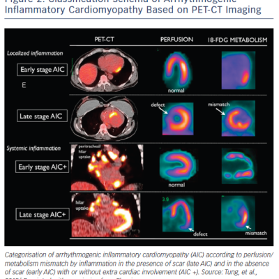 Figure 2 Classification Schema of Arrhythmogenic Inflammatory Cardiomyopathy Based on PET-CT Imaging