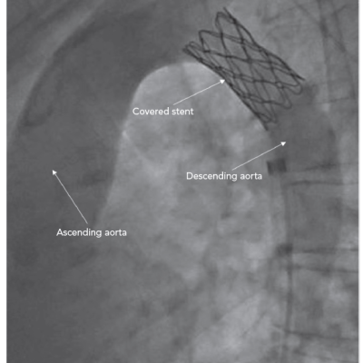 Coarctation Angiogram with Stent