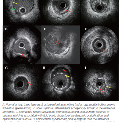 Common Morphologies of Intravascular Ultrasound