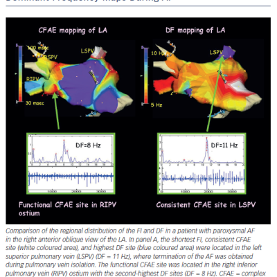 Figure 2 Complex Fractionated Atrial Electrogram and Dominant Frequency Maps During AF